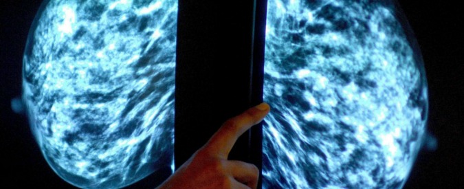 Cancro al seno, le breast unit solo in nove regioni ma ogni anno 48mila nuovi casi