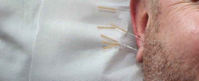 Agopuntura: perché è efficace e inutile – Parte I