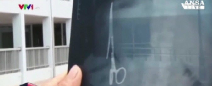 Copertina di Vietnam, per 18 anni vive con una forbice in pancia dimenticata in un intervento