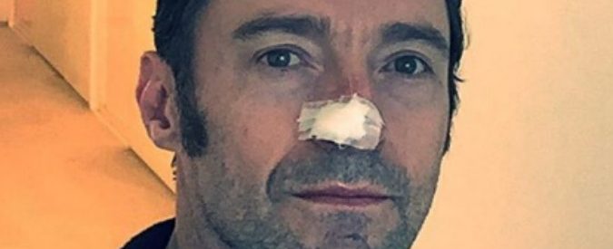 Hugh Jackman, nuova operazione per un tumore alla pelle