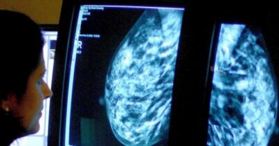 Copertina di Tumore al seno, così funzionano le mutazioni genetiche responsabili e i test da eseguire