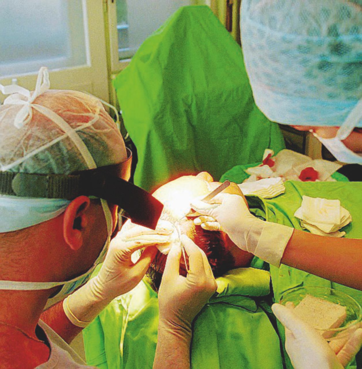 Attrazione sanitaria - Sono migliaia gli stranieri anche giovani che vanno in Turchia per il trapianto di capelli - LaPresse Vedi Istanbul e poi pettinati. Il boom dei turisti calvi