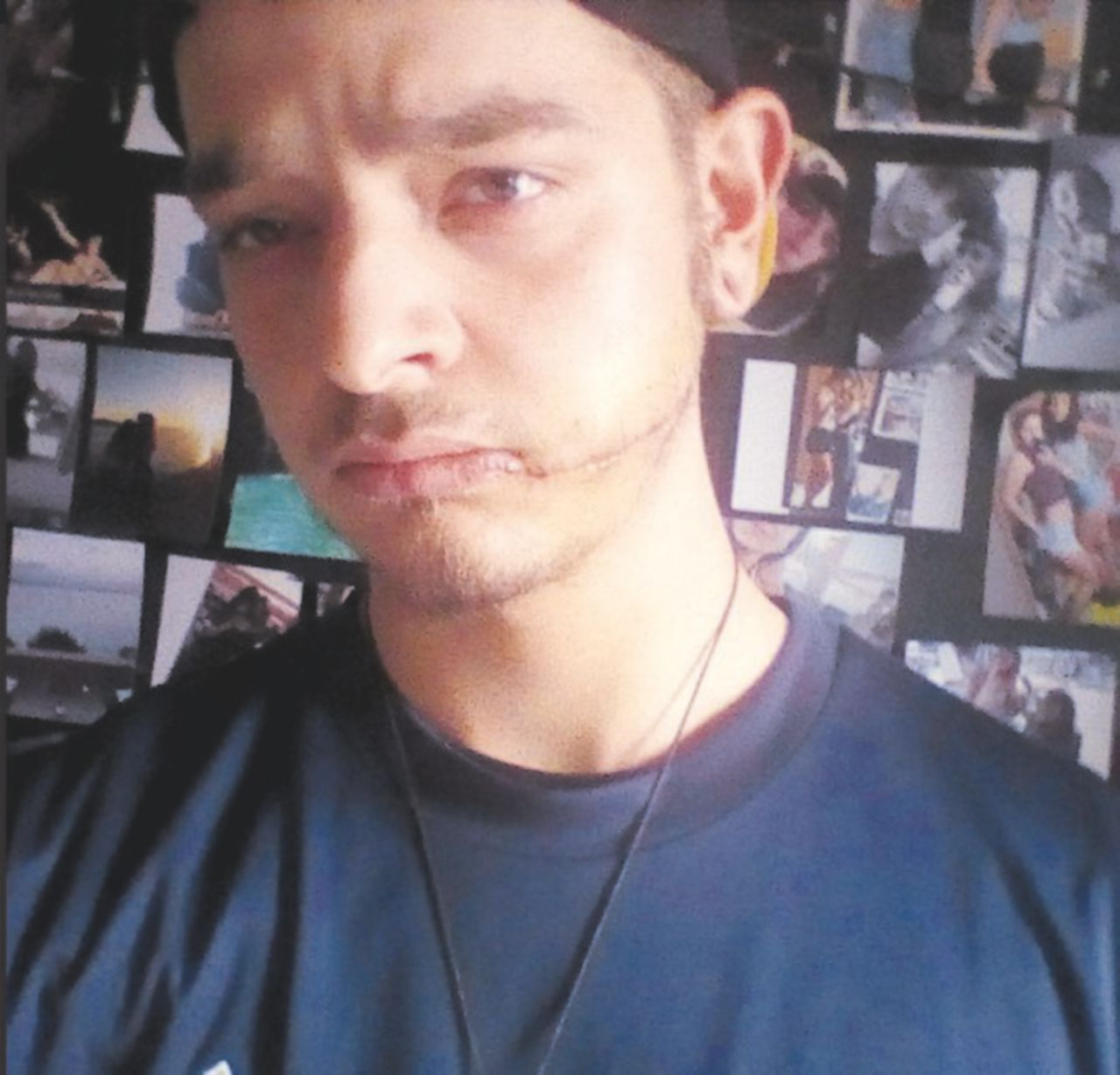 La ferita - Nicolas Del Bianco, 23 anni, mostra su Facebook la cicatrice sul volto - Facebook Sangue e coltelli, il duello rusticano per una donna