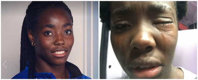 Daisy Osakue, ferita azzurra di atletica: colpita da un uovo. Gli inquirenti: “Già due casi con vittime bianche”