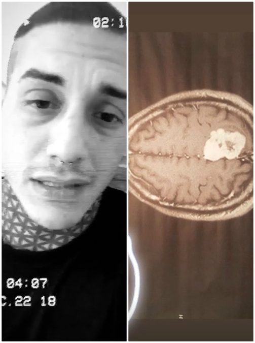 Copertina di Francesco Chiofalo, il dramma dell’ex di Temptation Island: “Ho un tumore al cervello”. E mostra la radiografia