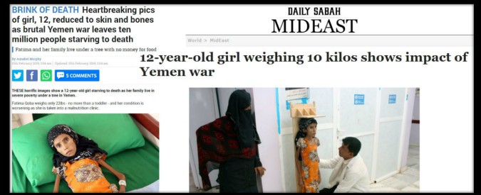 Yemen, la foto di Fatima diventa simbolo della guerra: a 12 anni pesa solo 10 chili. Msf: ‘Mancano cibo, trasporti e medici’