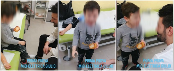 Copertina di Il piccolo Giulio indossa per la prima volta la protesi al braccio, la sua reazione emoziona: “Mamma, posso tenerla?”