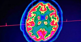Copertina di Alzheimer, così lo studio sull’Rna potrebbe portare “a un nuovo approccio per arrestare o ritardare” la malattia