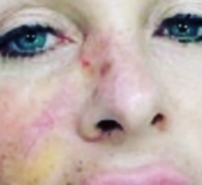 Paola Ferrari e la foto con il carcinoma al viso: “La prevenzione vi salva la vita”