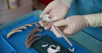 Copertina di Firenze, al Mayer ricostruito un orecchio a un paziente 13enne grazie alla stampante 3D