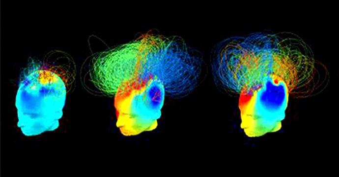 Segni di coscienza nascosta, lo studio: “Così le onde cerebrali anticipano la ripresa di pazienti con danni al cervello”