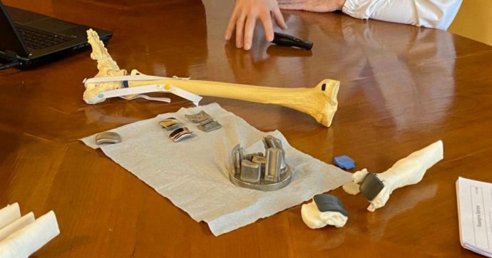 Ricostruita una caviglia con una stampa 3D: è la prima volta al mondo