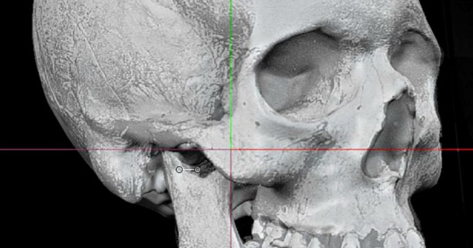 Il mistero del cranio conservato all’Accademia di Arte Sanitaria di Roma: “Potrebbe essere di Plinio il Vecchio”