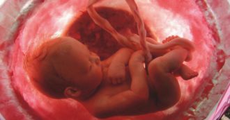 Copertina di Spina bifida, intervento in utero con un cerotto di staminali: tre bambini nati sani