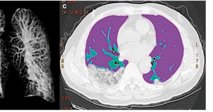 Lo Spallanzani: “Le lesioni ai polmoni del coronavirus non sono permanenti”