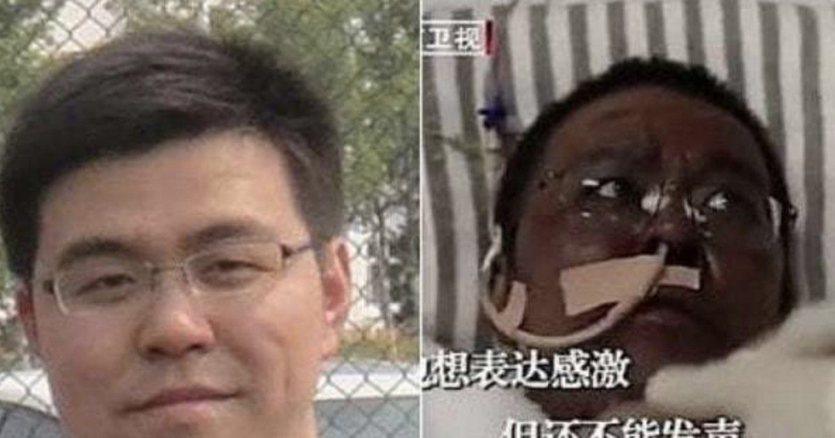 Coronavirus, morto uno dei due medici cinesi che si erano svegliati dal coma con la pelle più scura: “Deceduto a causa di diverse emorragie cerebrali”