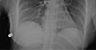 Copertina di Il seno rifatto devia la traiettoria del proiettile impedendogli di arivare al cuore: così una trentenne si salva la vita