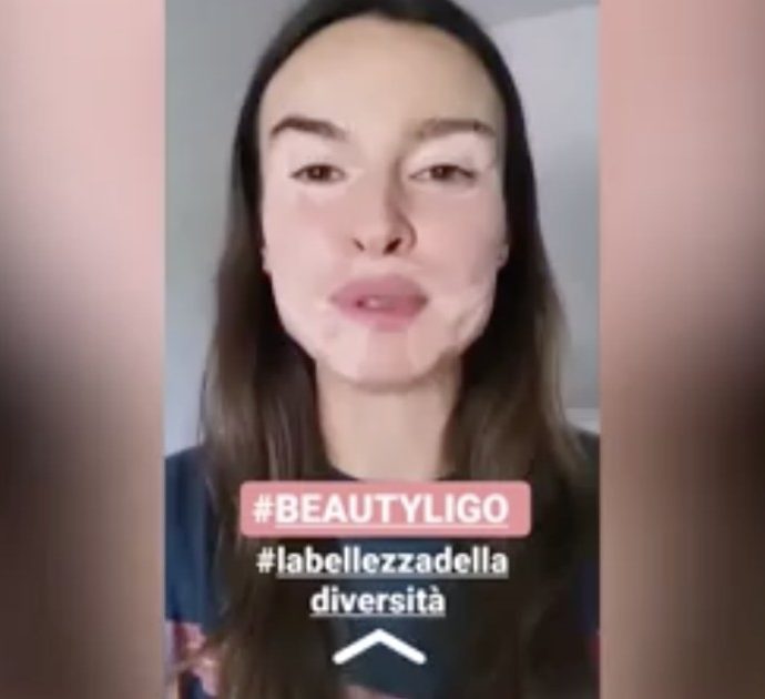 Kasia Smutniak inventa Beautyligo, il filtro alla vitiligine su Instagram: “Ognuno è bello a modo suo”