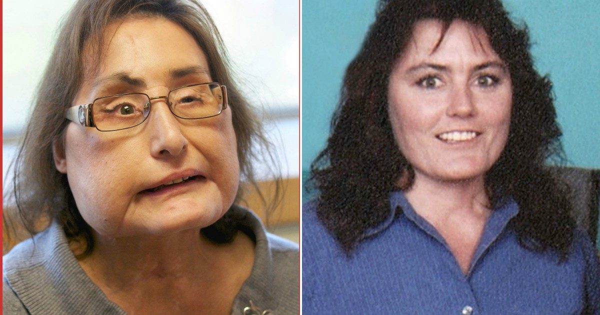 Morta Connie Culp, la prima donna a ricevere un trapianto di faccia: il marito aveva provato a ucciderla a colpi di fucile