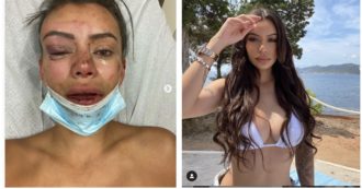 Copertina di Jasmine Cécilia, l’influencer mostra il volto tumefatto: “Mi ha preso a pugni e calci su tutto il corpo, avevo il naso rotto e il sangue che colava”