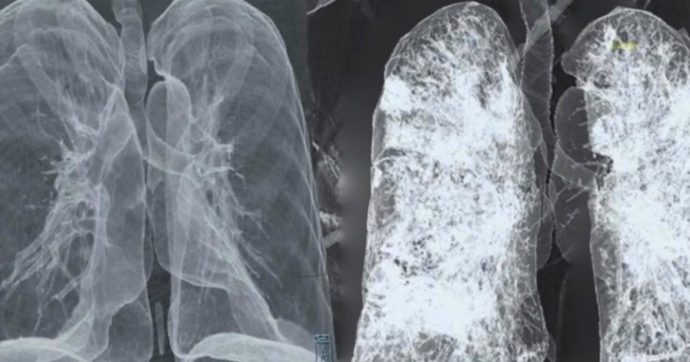 Gianluigi Nuzzi pubblica le immagini con gli effetti del Covid sui polmoni: “Da mostrare a chi ancora fa il pirla”