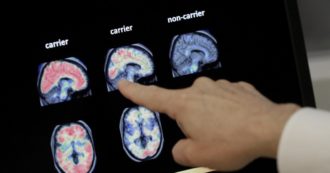 Copertina di Alzheimer, un algoritmo per scoprirlo con una semplice risonanza: lo studio britannico su Nature. “Diagnosi di rischio precisa al 98%”