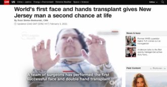 Un intervento di 23 ore per ricostruire faccia e mani. Così Joe ha avuto la sua seconda chance