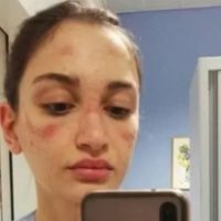 Il 10 marzo, Alessia Bonari, infermiera in un ospedale di Milano, posta una foto con i segni procurati da mascherina e visiera