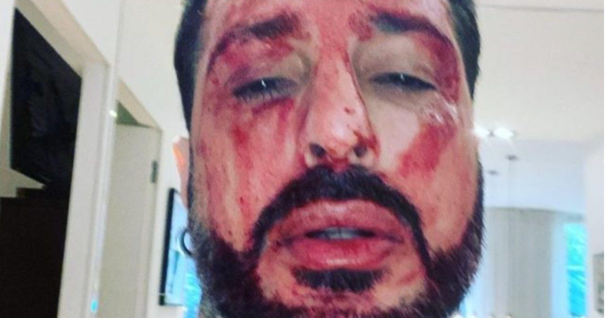 Fabrizio Corona si è ferito ai polsi: “Sacrificherò la mia vita”. Il gesto estremo dopo aver saputo di dover tornare in carcere – FOTO