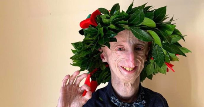 Sammy Basso e la progeria: “Per vivere prendo 8 pillole al giorno, ma siamo a un passo dal trovare la cura per questa malattia”