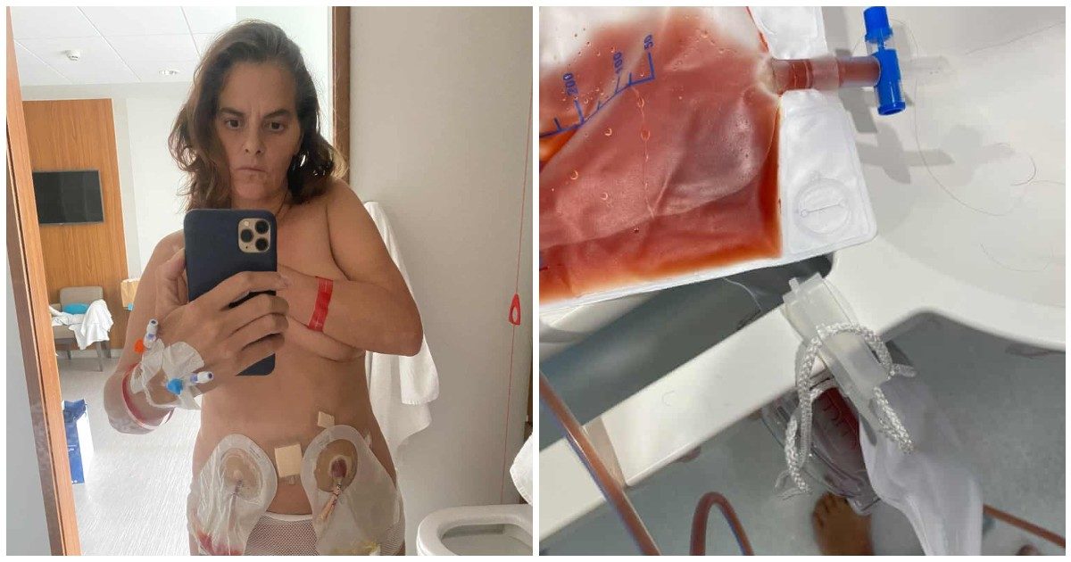 Tracey Emin, l’artista pubblica i selfie scattati durante la lotta al cancro alla vescica: “Per il resto della mia vita avrò una borsa piena di pi***o attaccata”