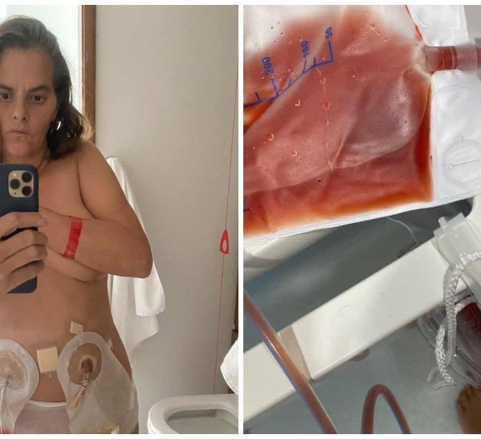 Tracey Emin, l’artista pubblica i selfie scattati durante la lotta al cancro alla vescica: “Per il resto della mia vita avrò una borsa piena di pi***o attaccata”