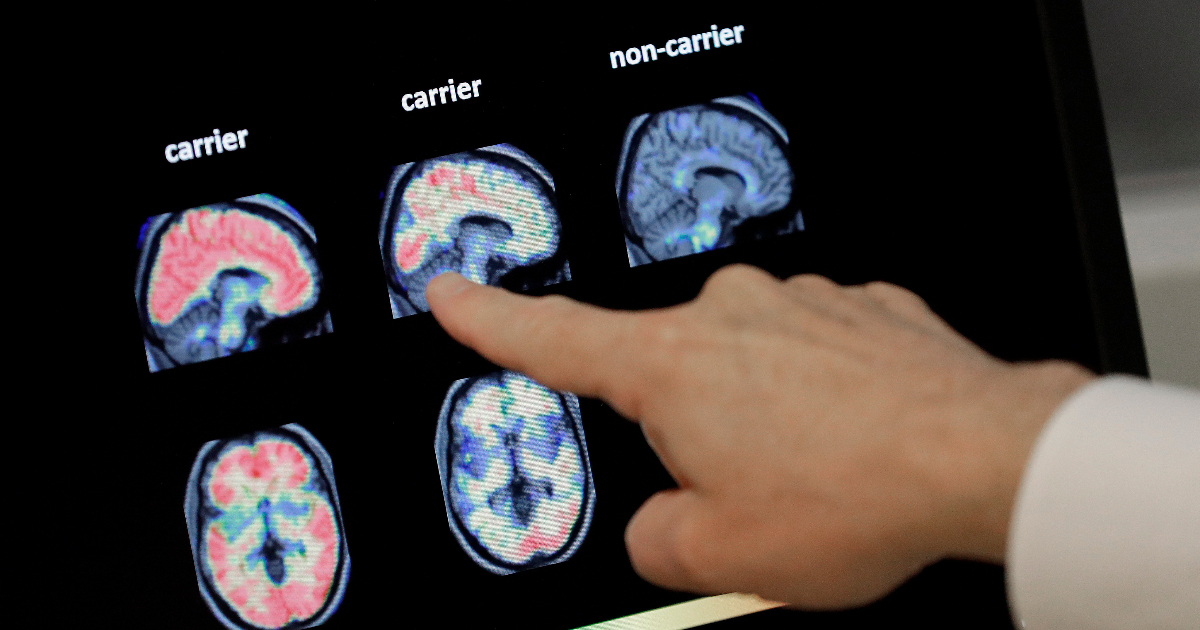 Enfermedad de Alzheimer, estudio en Science: «Gracias a las nanopartículas magnéticas se han cerrado los déficits de memoria»