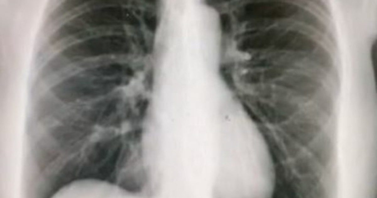 Fa una radiografia per la tosse e scopre di avere il cuore dalla parte destra del petto: “Ero scioccata e confusa, non ci credevo”