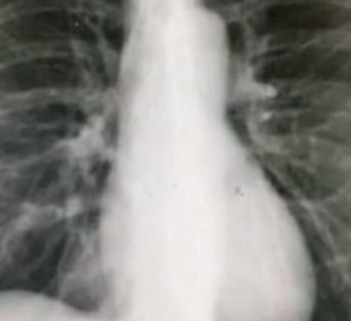 Fa una radiografia per la tosse e scopre di avere il cuore dalla parte destra del petto: “Ero scioccata e confusa, non ci credevo”