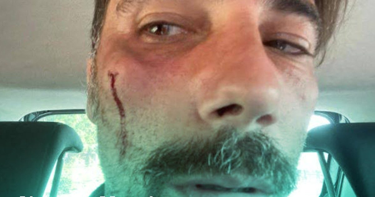 Vittorio Brumotti aggredito: trauma facciale e prognosi di 30 giorni. Lui: “Non mi fermerò”