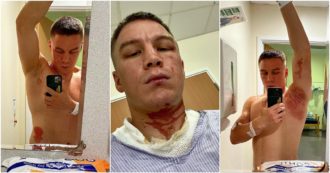 Copertina di Viktor Kotochigov, l’ex campione del mondo di boxe sfregiato con un acido: “Degli incappucciati sono entrati di notte in casa, ecco come mi hanno ridotto”