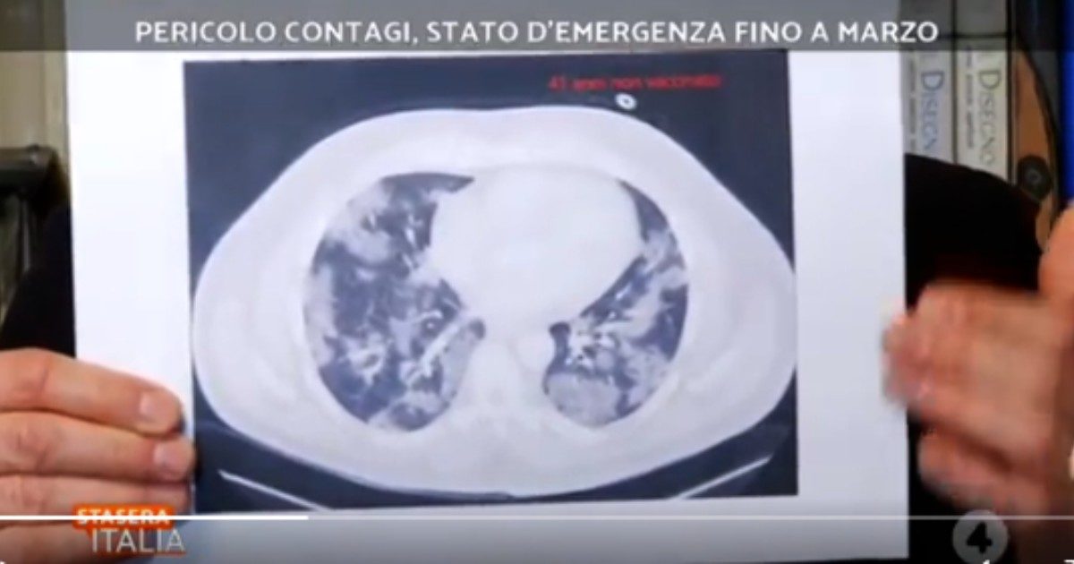 Stasera Italia, Bassetti mostra in diretta le tac dei pazienti no-vax: “Non avremmo dovuto più vedere queste immagini. Avete sulla coscienza molte vite”