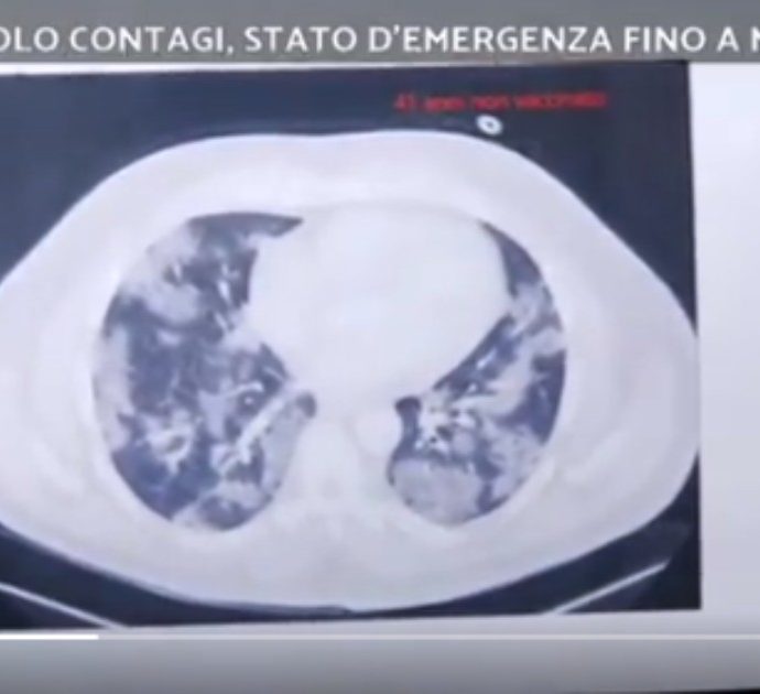 Stasera Italia, Bassetti mostra in diretta le tac dei pazienti no-vax: “Non avremmo dovuto più vedere queste immagini. Avete sulla coscienza molte vite”