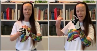 Copertina di Valentina Pitzalis ha una nuova mano bionica: “È fantastica ma non potrò mai essere di nuovo autosufficiente, neanche per lavarmi”