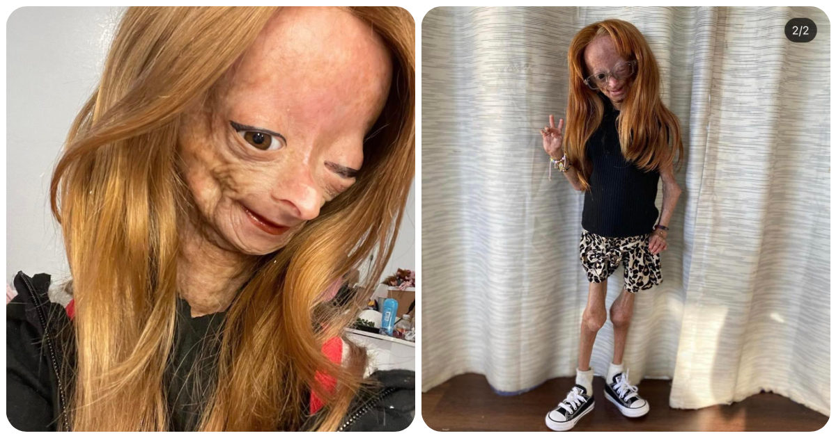 Morta Adalia Rose, la Youtuber di 15 anni affetta da progeria: “Adesso non soffre più”
