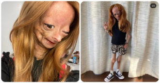 Copertina di Morta Adalia Rose, la Youtuber di 15 anni affetta da progeria: “Adesso non soffre più”