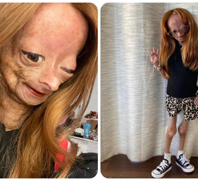 Morta Adalia Rose, la Youtuber di 15 anni affetta da progeria: “Adesso non soffre più”