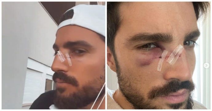 Mariano Di Vaio in ospedale dopo un incidente: “Una racchetta in faccia, speriamo che si riprenda presto”