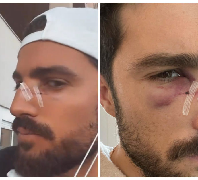 Mariano Di Vaio in ospedale dopo un incidente: “Una racchetta in faccia, speriamo che si riprenda presto”