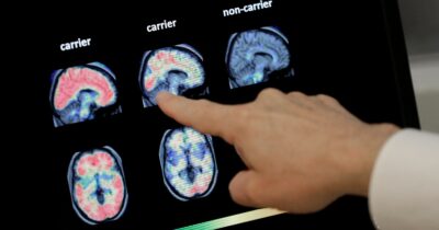 Copertina di Alzheimer, “scoperto un raro gene come causa della malattia in età senile”. Lo studio italiano