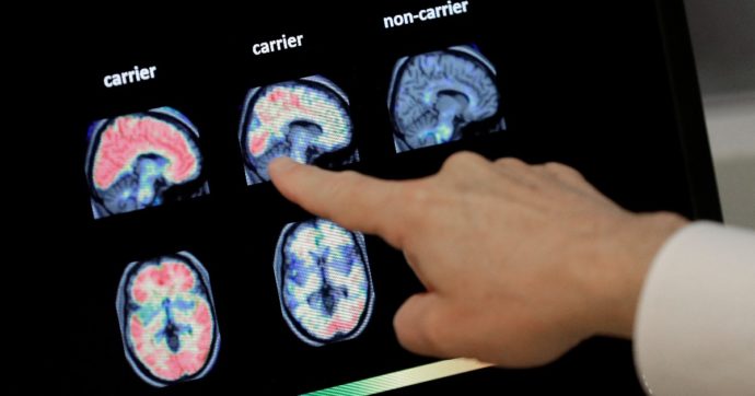 “Origine genetica comune tra la depressione e il morbo di Alzheimer”: lo studio dell’Emory University Center