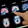 Copertina di Una terapia promette di salvare le funzioni cognitive dei malati di Alzheimer