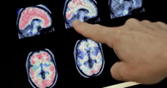Copertina di Cancro al cervello, “così una nanocapsula bioingegnerizzata potrà trasportare la terapia genica”