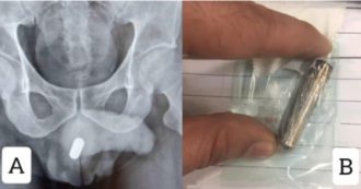 Copertina di Uomo finisce all’ospedale con una pila infilata nel pene: “L’ha tenuta per 24 ore. Cicatrici gravi all’uretra”